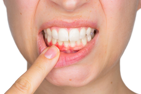 Diş Eti Hastalıkları ve Tedavisi (Periodontoloji)